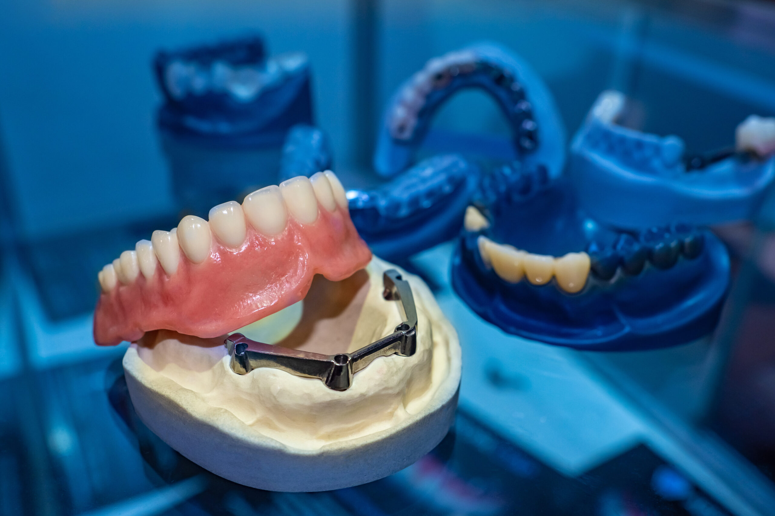 image of a dental implant denture on a prosthesis jaw in a dark and blue aesthetic dental room.