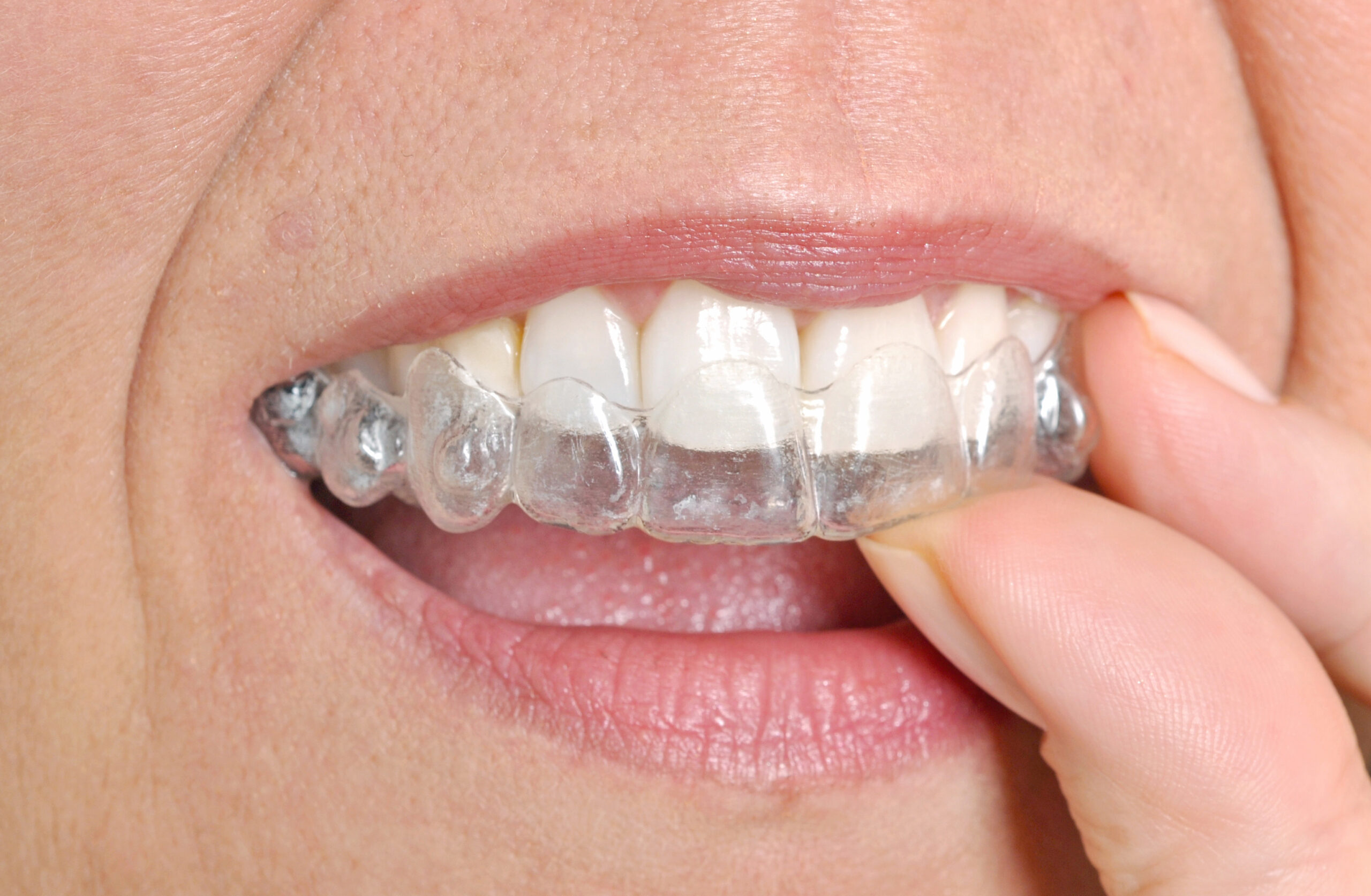 invisalign image of a dental patient.