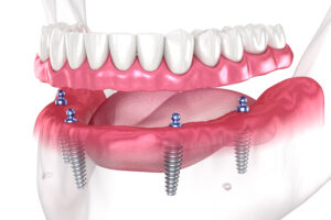an image of full mouth dental implant 3D model.