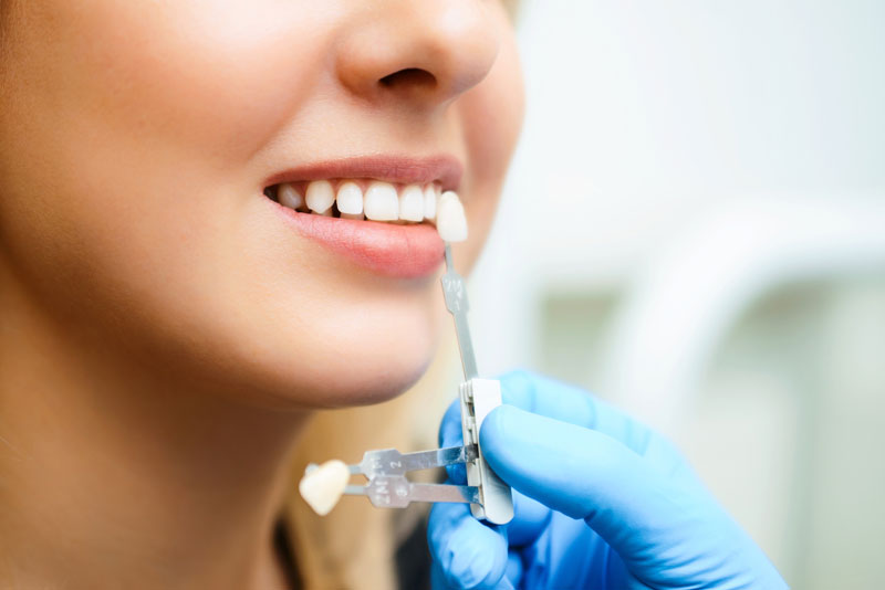 Doctor color matching a veneer for a patient’s tooth; holding device up to patients’ mouth.