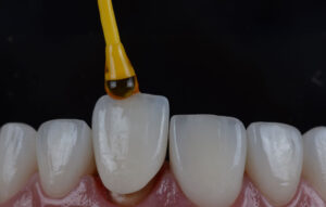 The image shows a close-up view of dental veneers being applied to teeth. A drop of adhesive is placed on a veneer, which is positioned on a tooth.