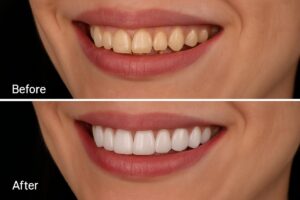 A set of before and after images showcasing a patient's smile transformation with porcelain veneers. The "before" image shows stained and slightly misaligned teeth, while the "after" image reveals a bright, straight, and natural-looking smile. No text.
